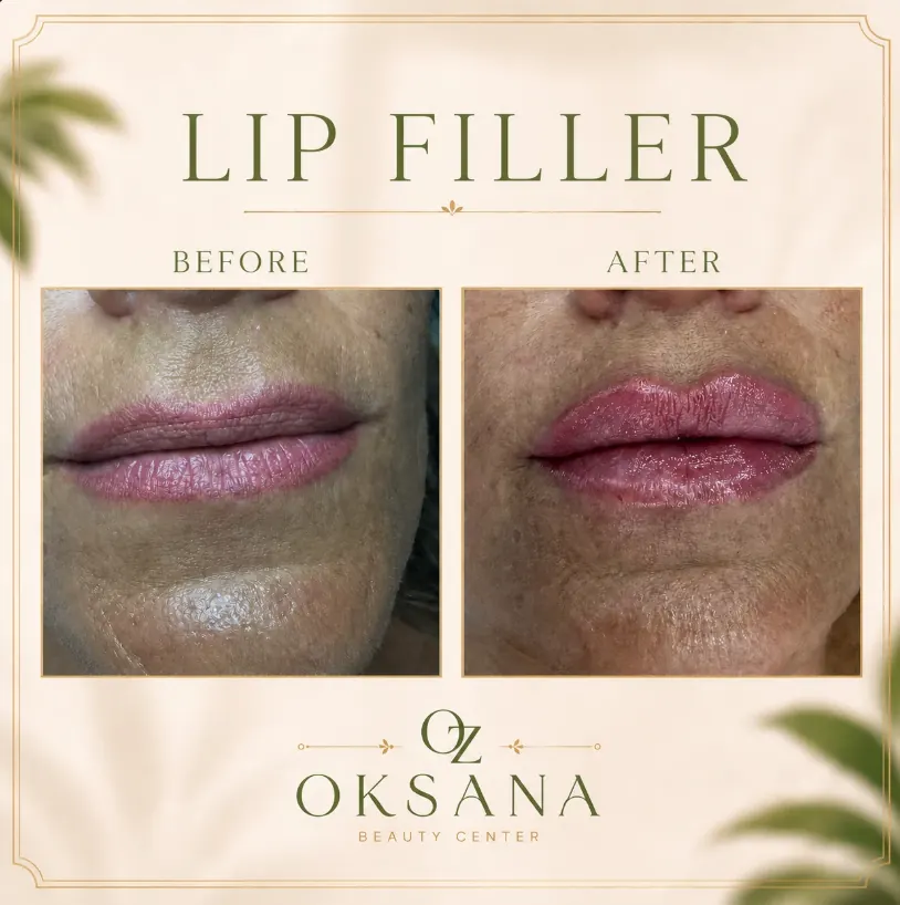 Рекламный креатив Lip Filler для Beauty Center